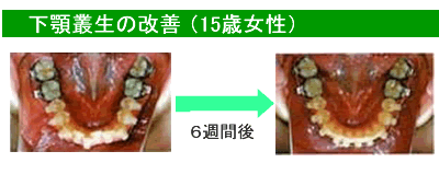歯列矯正 例2